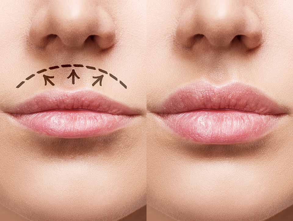 Lip lift Brussels : surgical reshaping of the upper lip